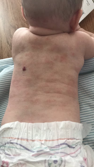 Baby Poppy with painful eczema rash all over her body.